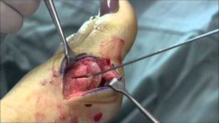 Bunion Surgery