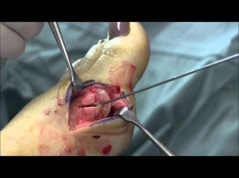 Bunion Surgery