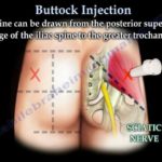 Buttock Injection – Everything You Need To Know – Dr. Nabil Ebraheim