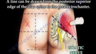 Buttock Injection – Everything You Need To Know – Dr. Nabil Ebraheim