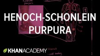 Henoch-Schonlein purpura | Circulatory System and Disease | NCLEX-RN | Khan Academy