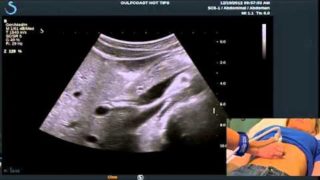 Hot Tips – Locating the Common Bile Duct with Ultrasound