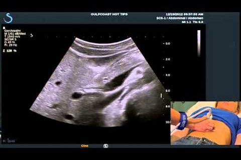 Hot Tips – Locating the Common Bile Duct with Ultrasound