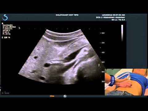 Hot Tips – Locating the Common Bile Duct with Ultrasound