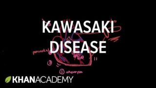 Kawasaki disease: diagnosis and treatment | Circulatory System and Disease | NCLEX-RN | Khan Academy