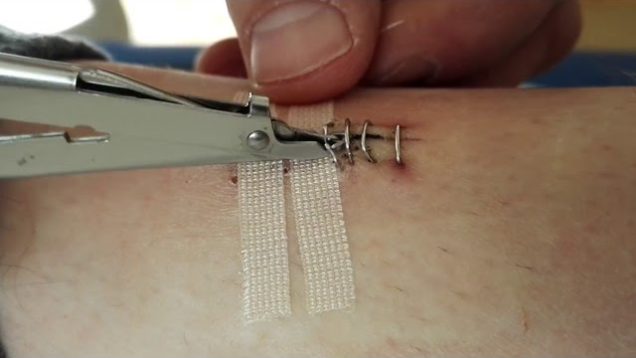 Klammern entfernen / Staple removal