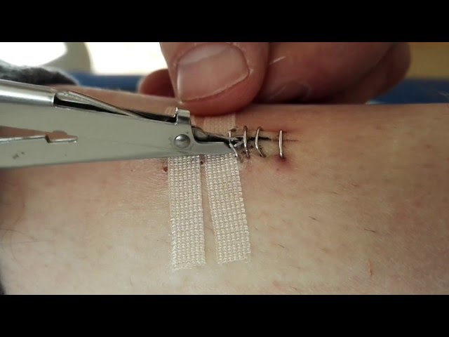 how-to-remove-surgical-staples-2023