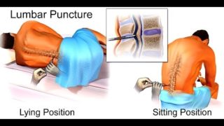 Mnemonic for Causes Of High Protein In the Cerebral Spinal Fluid (CSF), Mnemonic for NEET-PG