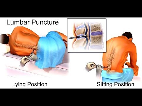 Mnemonic for Causes Of High Protein In the Cerebral Spinal Fluid (CSF), Mnemonic for NEET-PG
