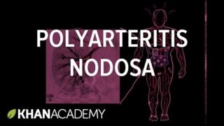 polyarteritis nodosa vasculitis