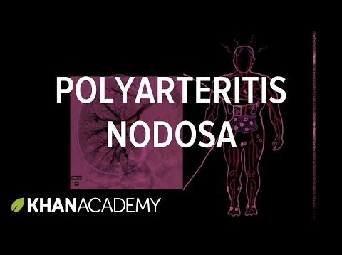 polyarteritis nodosa vasculitis