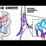 Portal Hypertension: Animated Review