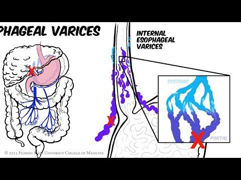 Portal Hypertension: Animated Review