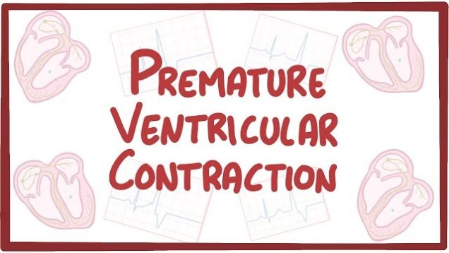 Premature Ventricular Contraction – causes, symptoms, diagnosis, treatment, pathology