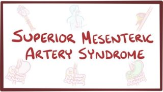 Superior Mesenteric Artery Syndrome – causes, symptoms, diagnosis, treatment, pathology