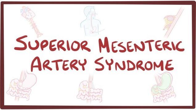 Superior Mesenteric Artery Syndrome – causes, symptoms, diagnosis, treatment, pathology