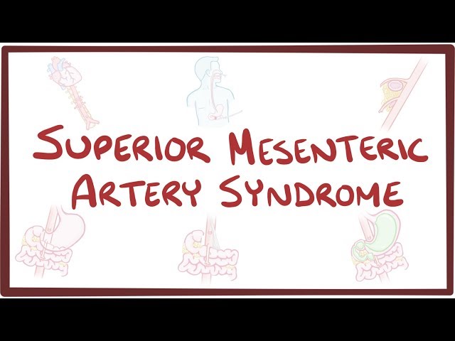 Superior Mesenteric Artery Syndrome - Causes, Symptoms, Diagnosis ...