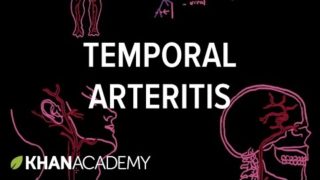 Temporal arteritis also known as Giant Cell Arteritis video lecture