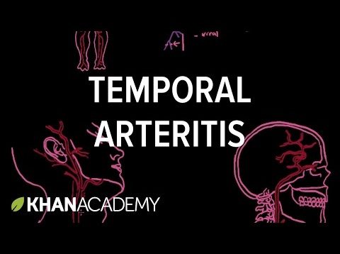 Temporal arteritis also known as Giant Cell Arteritis video lecture
