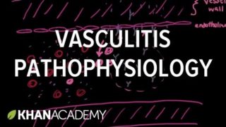 Vasculitis pathophysiology | Circulatory System and Disease | NCLEX-RN | Khan Academy