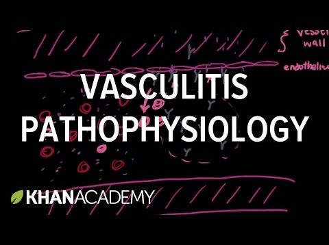 Vasculitis pathophysiology | Circulatory System and Disease | NCLEX-RN | Khan Academy