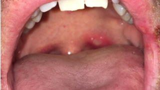 Peritonsillar Abscess – causes, signs, symptoms, diagnosis, treatment