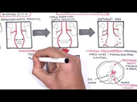 Abdominal Aortic Aneurysm – Summary