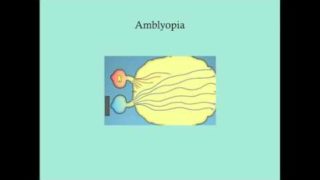 Amblyopia – CRASH! Medical Review Series