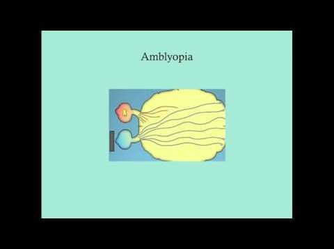 Amblyopia – CRASH! Medical Review Series