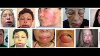 Angioedema – a medical minute