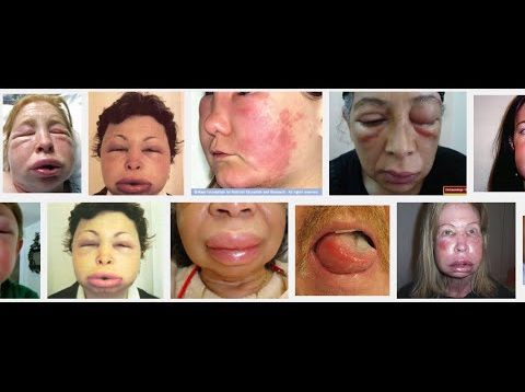 Angioedema – a medical minute