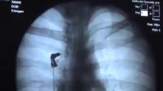 Barium Swallow Video