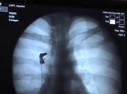 Barium Swallow Video