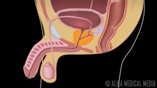 Benign Prostatic Hyperplasia (BPH) and Treatments, animation.