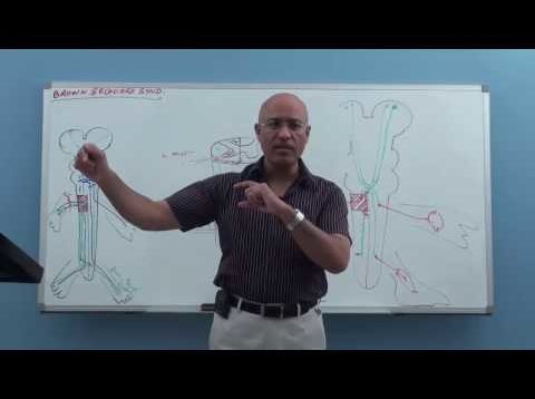 Brown Sequard Syndrome – Internal Medicine