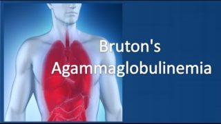 Bruton’s agammaglobulinemia