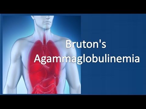 Bruton’s agammaglobulinemia