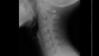 Cervical Spine Radiology Tutorial