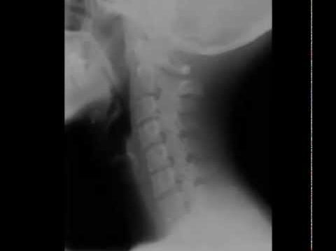 Cervical Spine Radiology Tutorial