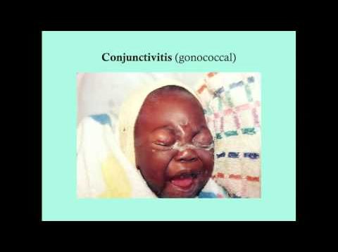 Conjunctivitis – CRASH! Medical Review Series