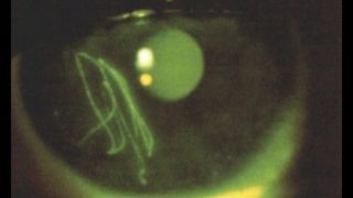corneal abrasions