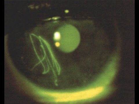 corneal abrasions