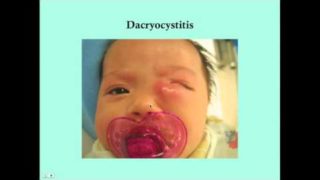 Dacryocystitis – CRASH! Medical Review Series