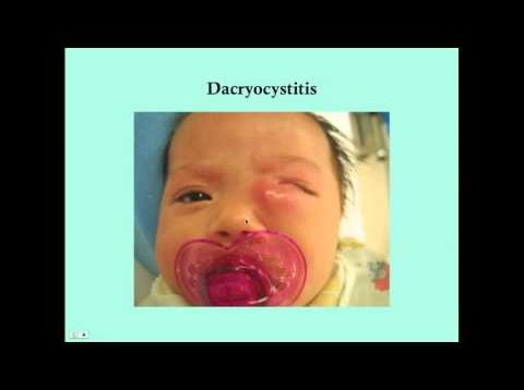 Dacryocystitis – CRASH! Medical Review Series