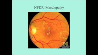 Diabetic Retinopathy – CRASH! Medical Review Series