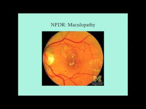 Diabetic Retinopathy – CRASH! Medical Review Series