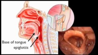 Epiglottitis