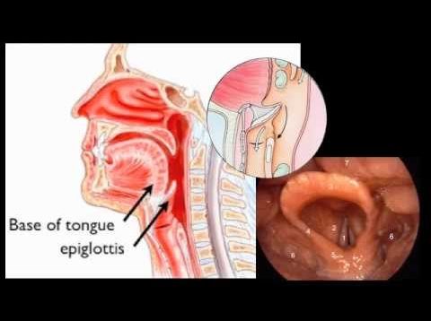Epiglottitis