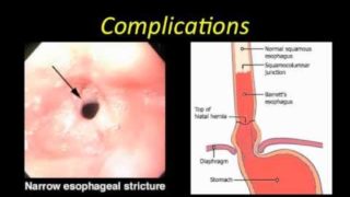 Esophagitis