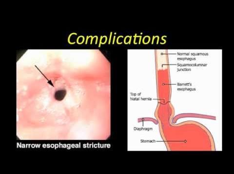 Esophagitis